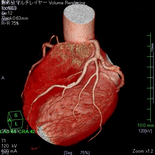 心臓CT