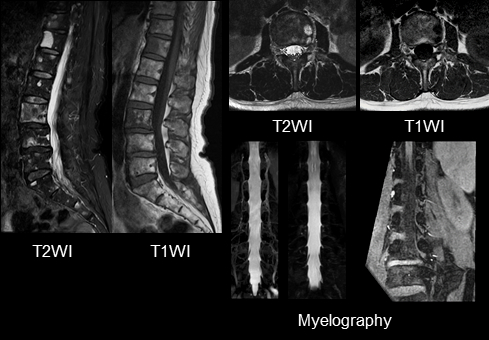 腰椎MRI